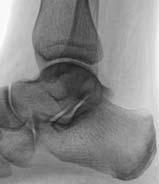 MORTISE INHERENTLY UNSTABLE MEDIAL MALLEOLUS / ANTERIOR COLLICULUS SUPERFICIAL DELTOID LIGAMENT A P ROLE