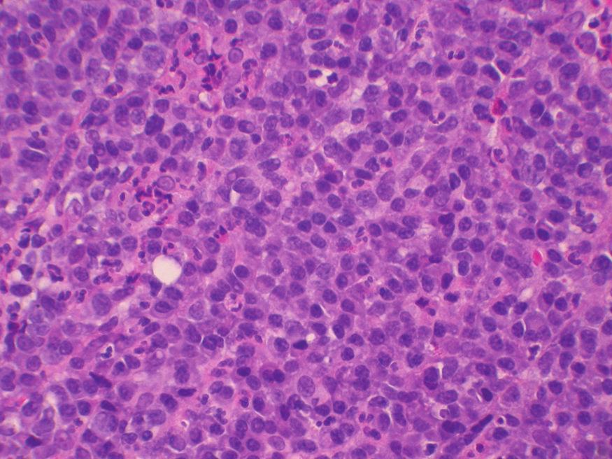 Figure 3: High power (40x) shows an H&E stained section with sheets of plasma cells, many with prominent nucleoli. lymph node was identified in the left paratracheal position measuring 1.3 cm.