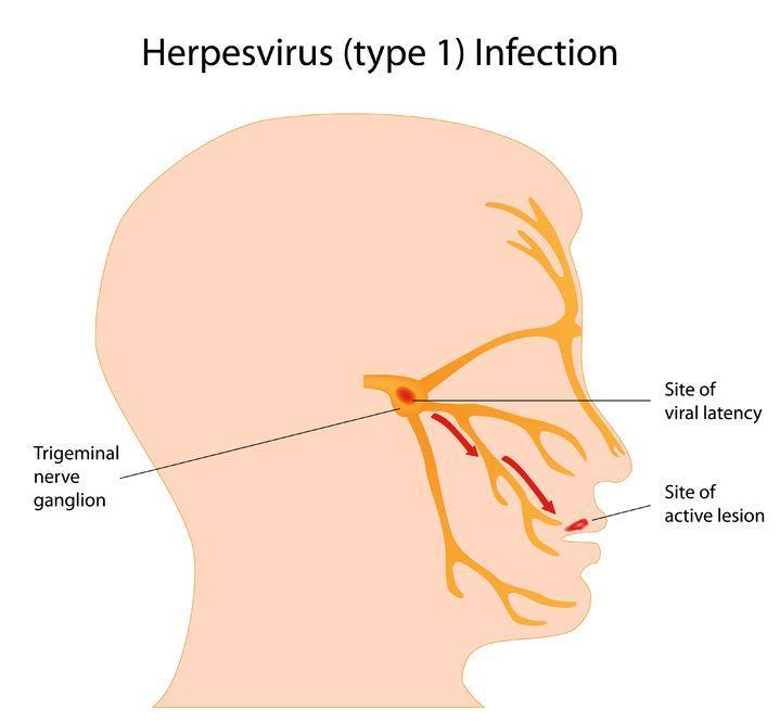 HSV Latency Following primary infection, the virus enters sensory nerve endings at the site of inoculation, travels up the axon and establishes a latent infection in the ganglion supplying that area
