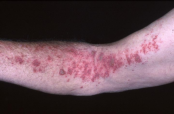 Shingles (Zoster) Reactivation lesion of VZV Like HSV, VZV establishes a latent infection in sensory ganglia.