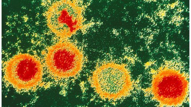 Epstein-Barr Virus EBV was discovered in 1964. Infection is widespread.
