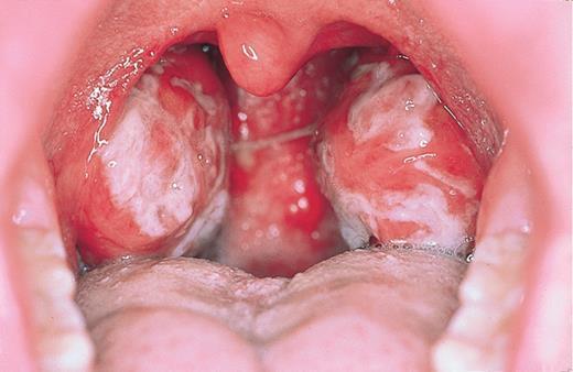 Clinical Syndromes associated with EBV infection: EBV 1) Infectious Mononucleosis (primary