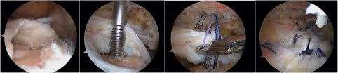 Rotator Cuff Tear Prevalence (full thicknes): 7-40% Increase with patient age Enlargement painfull