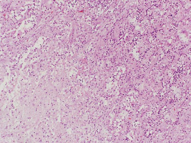 ACANTHAMOEBA IN LIVER TRANSPLANT 309 he developed several attacks of generalized tonic clonic convulsions and became drowsy. There was minimal neck stiffness.