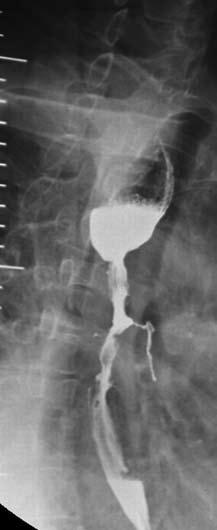 3 Esophageal stent for malignant dysphagia esophageal stenosis and bronchoesophageal fistula.