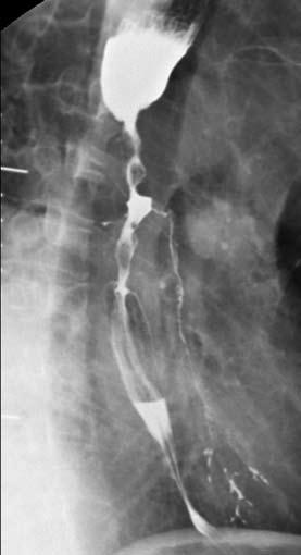 A 5-Fr Headhunter catheter and a soft-tip Bentson guide wire were then advanced via the mouth into the esophagus at the level of the T5 T7 vertebrae in accordance with the findings of the previous