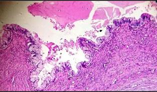 Fig. 2: Serous cystadenocarcinoma ovary Fig. 3: Mucinous cystadenocarcinoma 10x Fig.