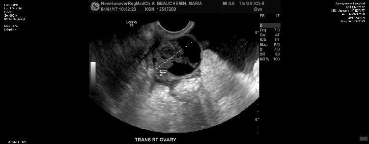 Transvaginal view Transverse Right Ovary Right Ovary seen with