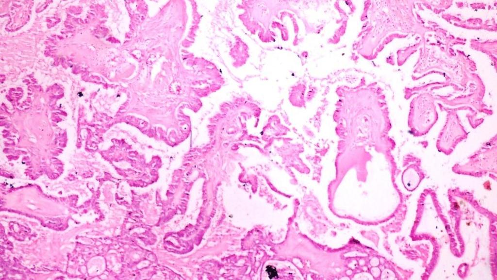 There were 11 cases (15.06%) of Germ cell tumours of which 9 cases (12.32%) were of Benign cystic teratoma (Figure III) and 2 cases of Dysgerminoma.
