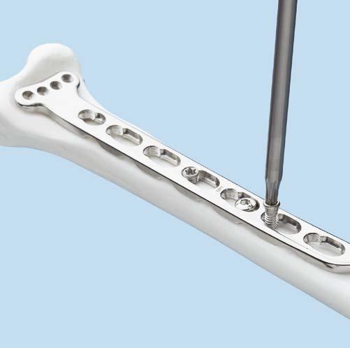 Insert Proximal Screws 6 Insert proximal screws Instruments 310.25 2.5 mm Drill Bit, quick coupling, 110 mm 310.288 2.8 mm Drill Bit, quick coupling, 165 mm 312.648 2.8 mm Threaded Drill Guide 314.