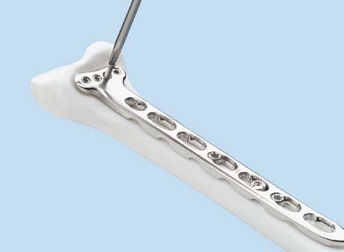 Insert Distal Screws 7 Insert distal screws and confirm joint reconstruction Instruments 310.509 1.
