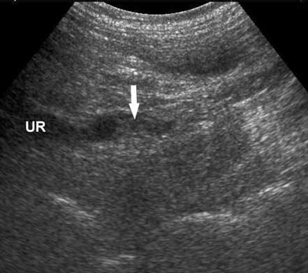 Necrosed Renal Papillae Causing Hydronephrosis Sonography was done with HDI 3500 and HDI 5000 systems (Philips Medical Systems, Bothell, WA) and broadband convex probes of 2 to 5 and 4 to 7 MHz and a