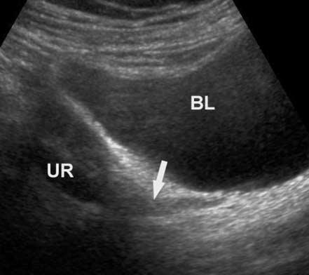 Vijayaraghavan et al Figure 3. Oblique sonogram through the urinary bladder showing the soft tissue of a necrosed papilla filling the distalmost ureter (arrow).