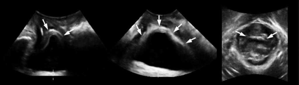 406 Wong et al. Figure 1 Mesh location (arrows) on four-dimensional transperineal ultrasound in mid-sagittal (a), coronal (b) and axial (c) planes on maximum Valsalva.