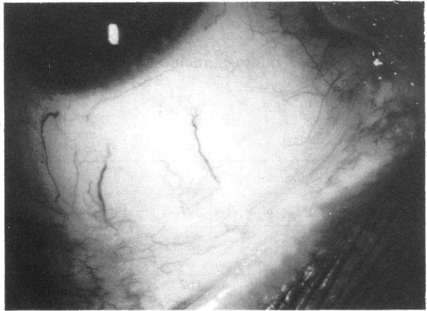 If fine linear scarring was included as a significant feature, evidence of a cicatrising conjunctival disorder was found in six patients (43%).