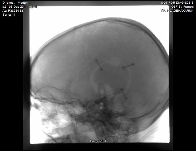 Follow Up Care Case study Repeat angiogram at 1 year Angiography and MRI studies often reveal a reduction in moyamoya vessels that closely parallels improvement in symptoms Patient is a 34-year-old