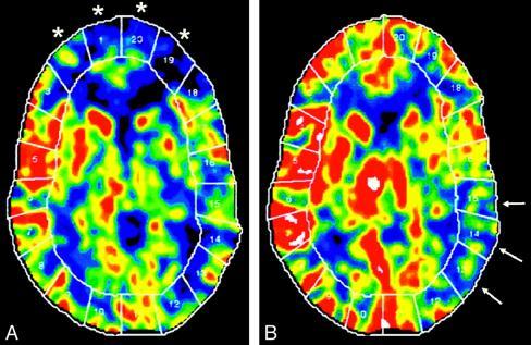 CT perfusion With and without diamox (acetazolamide) The initial CTA indicates baseline cerebral blood flow and identifies areas of low perfusion.