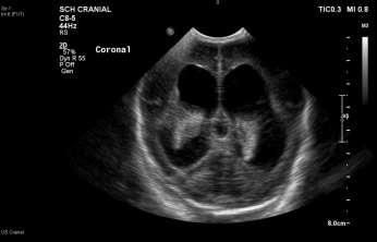 IVH Ultrasound