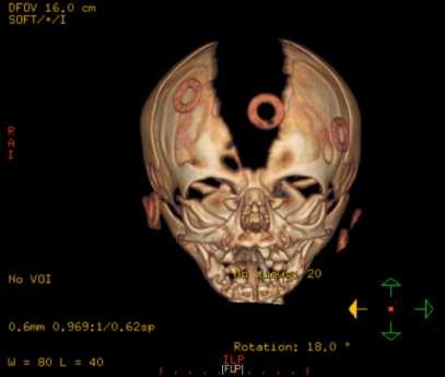 Neuroimaging in the Neonate with IVH CT with 3D