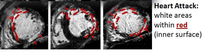 Cardiac MRI (CMR): The Heart in DMD