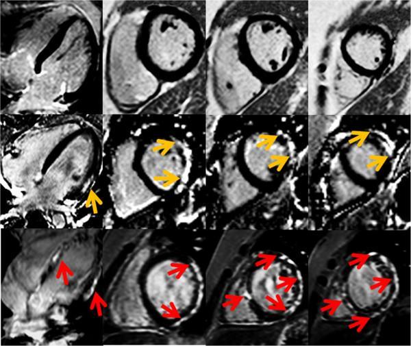 Hor et al, JCMR, 2013 Cardiac MRI (CMR): The Heart in DMD Beyond Squeeze (fibrosis/scar imaging) 17% of boys less 10 years of age has scar (youngest was 6.