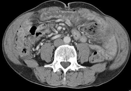 64 yr old with abdominal pain and partial SBO CT