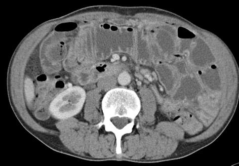 bowel thickened No visible transition point