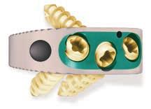 Introduction The Solitaire Anterior Spinal System, available in PEEK-OPTIMA and Titanium, is designed for use with autograft and is indicated for stand-alone intervertebral body fusion at one or two