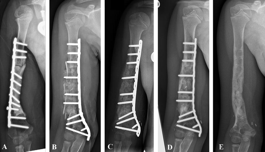 Induced membrane technique for reconstruction after bone tumor resection in children 305 Figure 1 Patient 8: Ewing sarcoma of the right humerus in a 7.5 year-old girl.