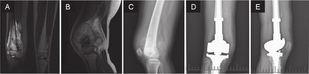 (C) An X ray image shows the separation of the epiphysis from the metaphysis (white arrow).
