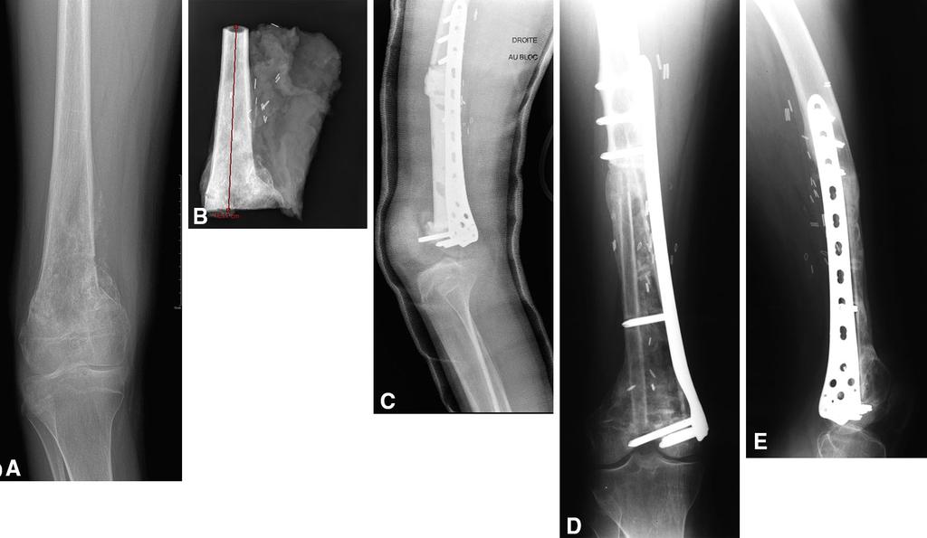 Volume 473, Number 6, June 2015 Induced-membrane Technique 2071 b Fig. 1A G (A) The AP radiographic view shows an Ewing sarcoma of the proximal left humerus (Patient 2).