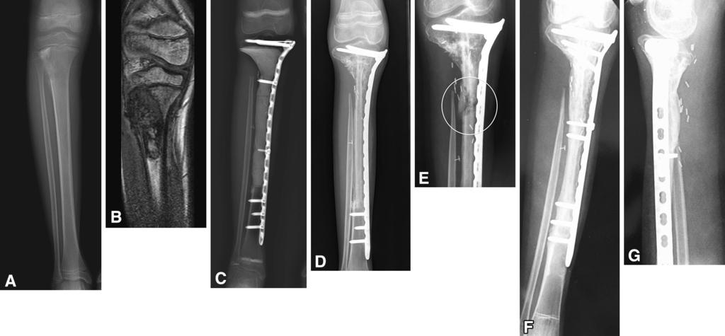 2072 Fitoussi and Ilharreborde Clinical Orthopaedics and Related Research 1 Fig.