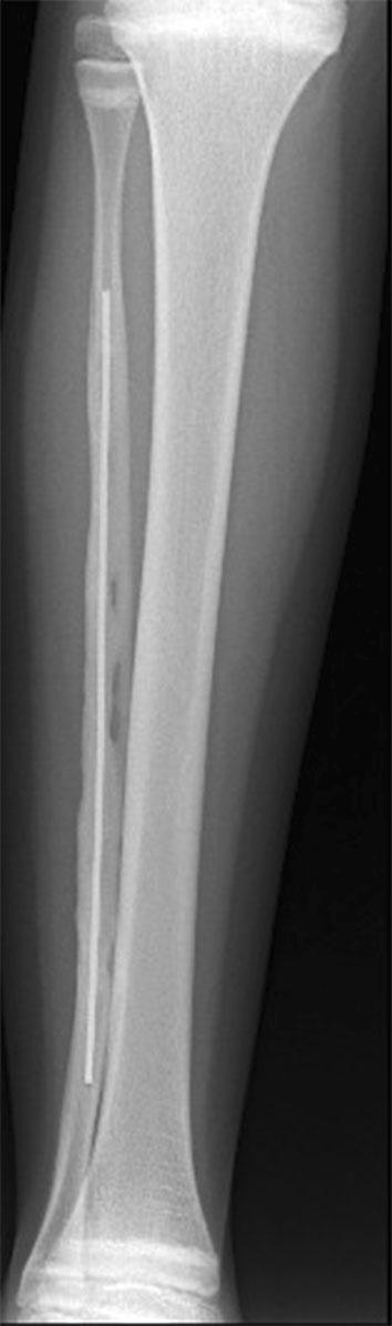 Another reported complication is massive graft resorption after femur reconstruction [2].