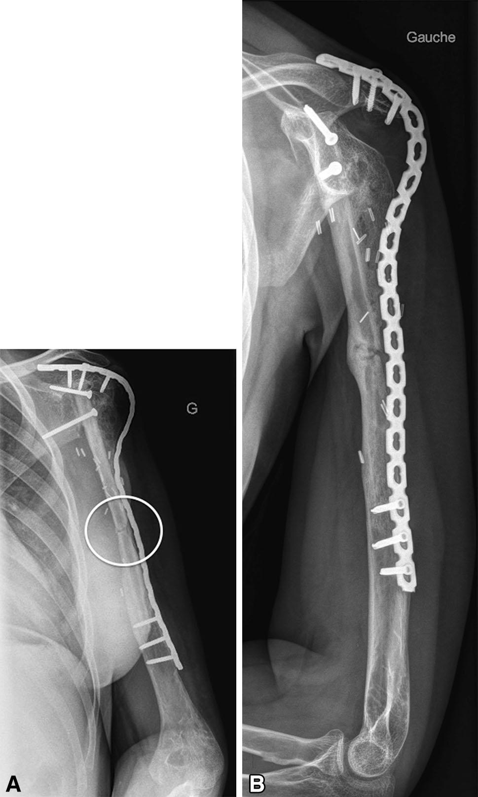 Volume 473, Number 6, June 2015 Induced-membrane Technique 2073 Fig. 5A B (A) An AP radiographic view obtained 2 months after the second-stage surgery shows a fracture of the fibula (Patient 6).