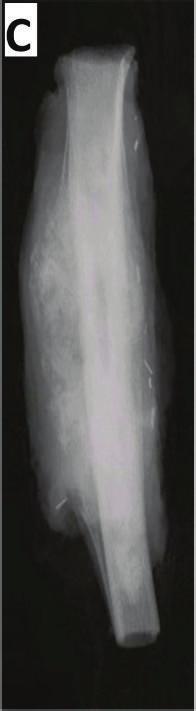 One patient had significant skin necrosis at the surgical site. The gastrocnemius flap also failed and a free latissimus dorsi flap was used successfully to cover the defect.