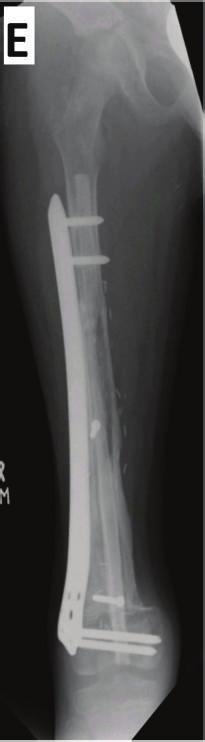 Two patients had nonunion at osteotomy sites. Revision procedures were done in both cases after waiting for one year.