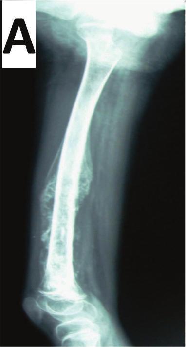 6 BioMed Research International (a) (b) (c) (d) (e) (f) (g) Figure 2: A 10-year-old girl with Ewing s sarcoma. (a) X-ray shows mass in mid and distal right femur.