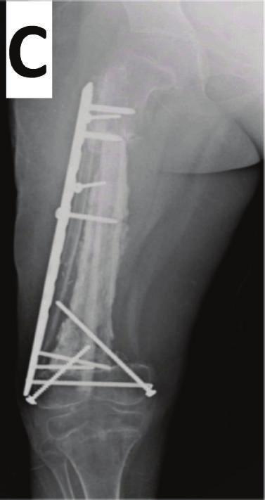 the osteotomy sites and thereby minimise the time to union, reduce bone resorption, and improve structural stability [28].