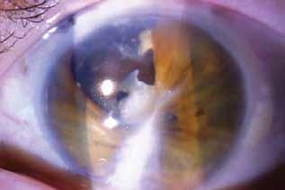 Figure 1. The left eye of a 62-year-old woman with a childhood history of trauma leading to a corneal scar, with iris adherent to the cornea and membrane obstructing the view of the retina. Figure 3.