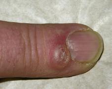 Case 2 A Finger Nodule A 46-year-old man presents with a five-month history of an asymptomatic pinkish-red nodule on his index finger. He is otherwise healthy.