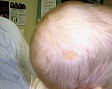 Case 5x A Yellowish Scalp Lesion This six-month-old child was noted to have a yellowish, round lesion on her scalp shortly after birth. The lesion is devoid of hair. a. Cradle cap b.