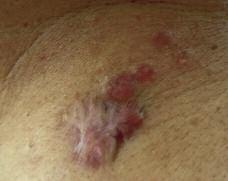 Case 7 A Thick, Pruritic Scar A 55-year-old male presents with a red, thick, pruritic scar on his shoulder several weeks after a biopsy of an unusual mole. a. Hypertrophic scar b. Keloid scar c.
