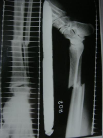 knee pain and 1(4%) each of delayed union, deformity, decreased knee movements and pain at screw site(table 1).