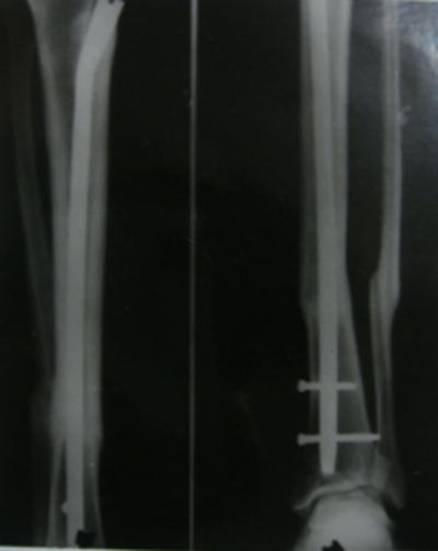 Figure 7 Fig 4:Radiograph showing union to fall while as in Wiss (1986) series of patients 84% of the fracture was due to automobile accidents.