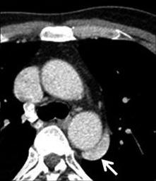 Liver dynamic CT was checked to identify the anatomy of her abdominal organs. The symmetric liver and gallbladder with multiple sandy stones were midline.