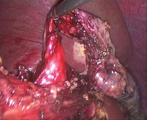 Case Reports in Surgery 3 (D) (c) Figure 3: Laparoscopic cholecystectomy picture.