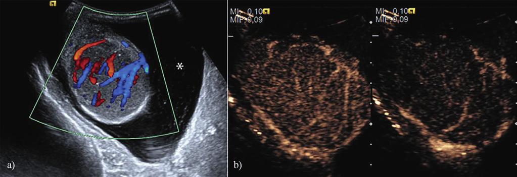 Med Ultrason 2016; 18(1): 110-115 111 Fig 1. a) Color Doppler ultrasonography in a patient with acute orchitis.