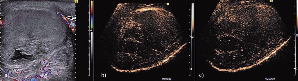 112 Radu Badea et al Contrast enhanced harmonic ultrasonography for the evaluation of acute scrotal pathology. Fig 3. US in a patient with testicular torsion.