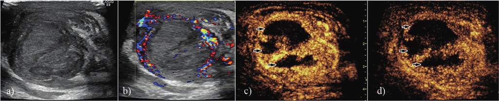 Med Ultrason 2016; 18(1): 110-115 113 Fig 5. Testicular necrosis after testicular torsion. Grey-scale US showed an inhomogeneous parenchyma, with hypoechoic areas inside (a).