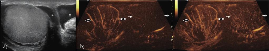 In order to evaluate the remaining viable tissue, CEUS was performed. Multiple, large areas of testicular tissue without enhancing during the arterial phase (c) or the venous phase (d) were detected.